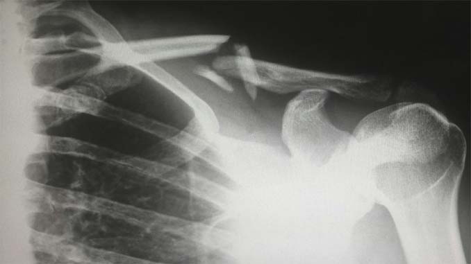 X-ray Of A Broken Bone